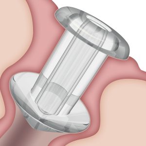 Tåreplugger, microkirurgi og instrumenter